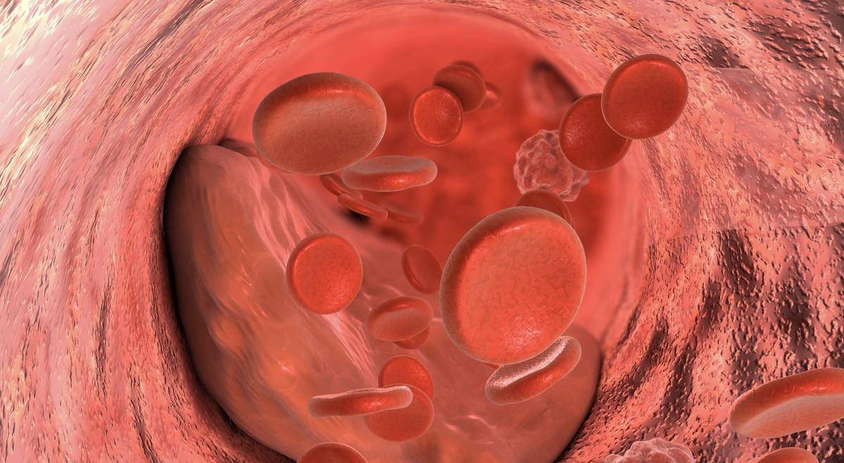 血液|有的人血压、血脂、血糖都不高，为什么也会患脑梗死？