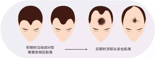 生长期|古芳栢草：晚期的M型脱发症状有哪些？