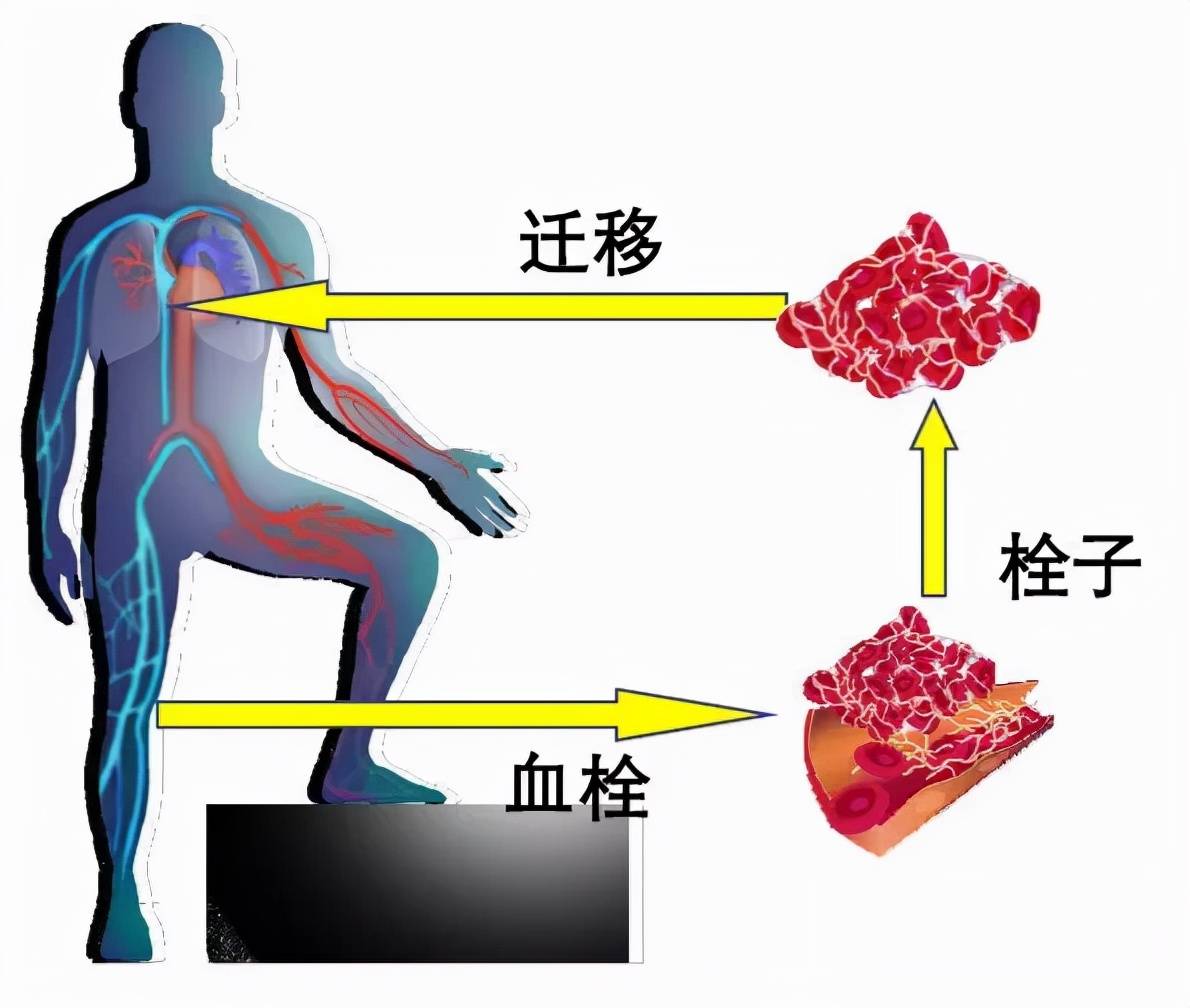 需要提高对预防静脉血栓栓塞症的认识,特别是有上述vte危险因素的人群