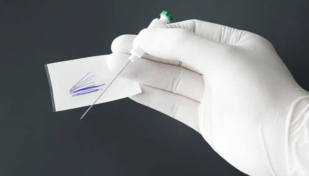 常规埋线,穴位局部皮肤常规消毒,采用一次性使用智象埋线针和2-0线体