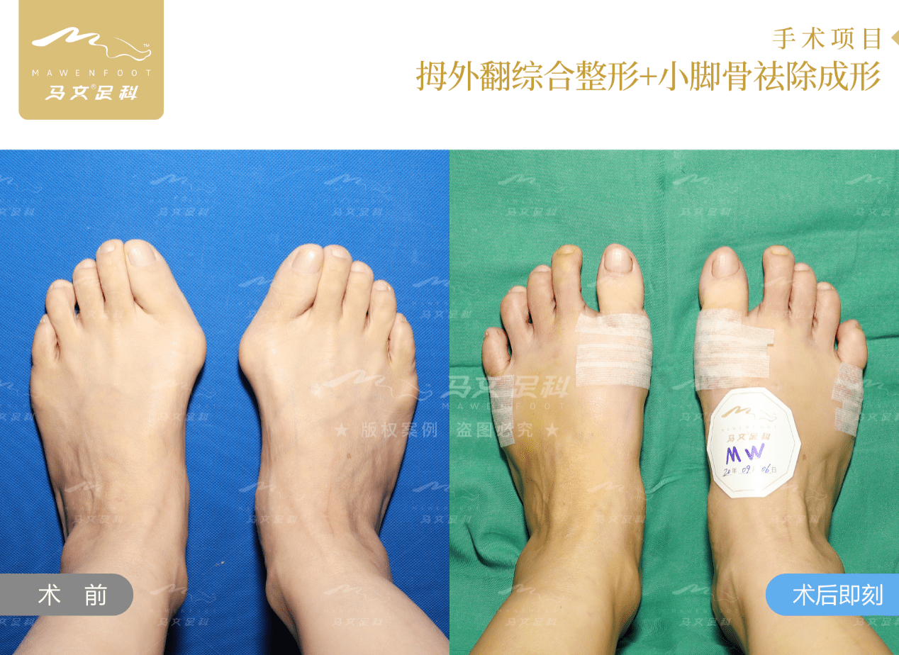 大脚|患者自述：“穿小鞋”掩饰大脚骨不可取——马桂文院长