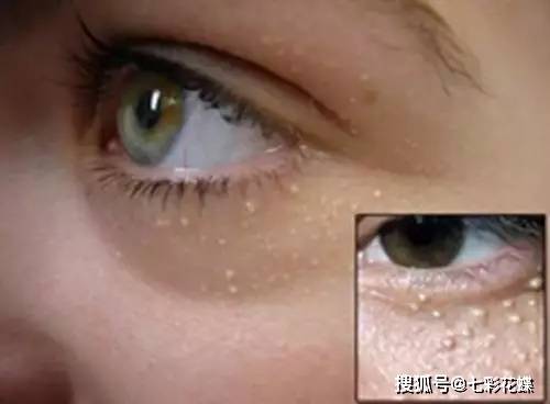 下巴锐生老师护肤小课堂|：眼睛周围长满了脂肪粒？护理预防学习起来
