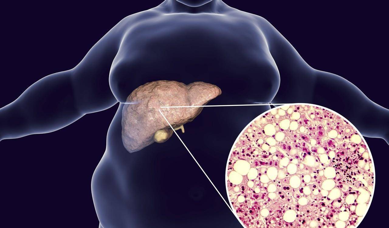 严重|肝损伤是怎么引起的？帮你揪出5大“诱因”，一定要注意避免