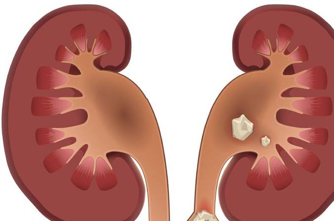 肾脏|肾结石痛到满地打滚，牢记3个原则，轻松排出肾结石！