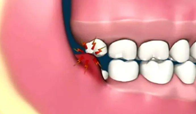 妙手|智齿牙根弯曲紧贴神经管，医生妙手微创拔除