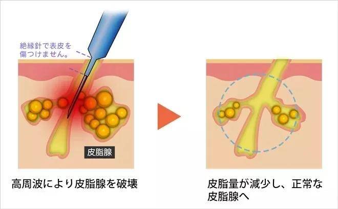 因为油性皮肤，干性皮肤该如何正确做好皮肤护理预防长痘？