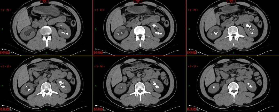 造影|年纪轻轻肾结石频发，当心海绵肾，别等出现感染才发现