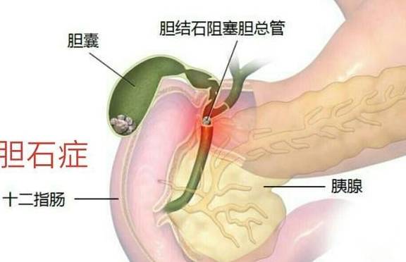 胆结石患者吃什么药可以缓解症状 有哪些需要注意的问题 胆囊