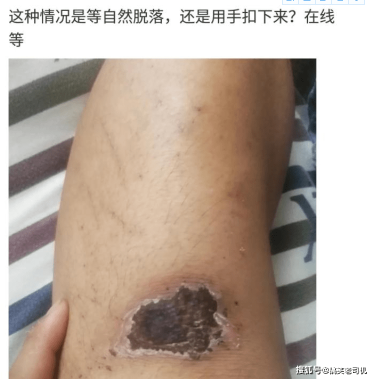 啥东西止血 d912a276e82a4087b29358b8f1fc9488.png