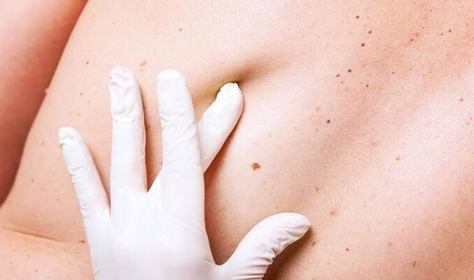 肝脏|辟谣！皮肤长红痣是肝病标志？其实可能是3种情况，很多人都搞错