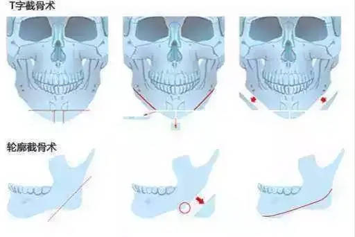 颅骨日式小颜整骨,真的能让大饼脸变成小V脸么?几个小技巧轻松瘦脸