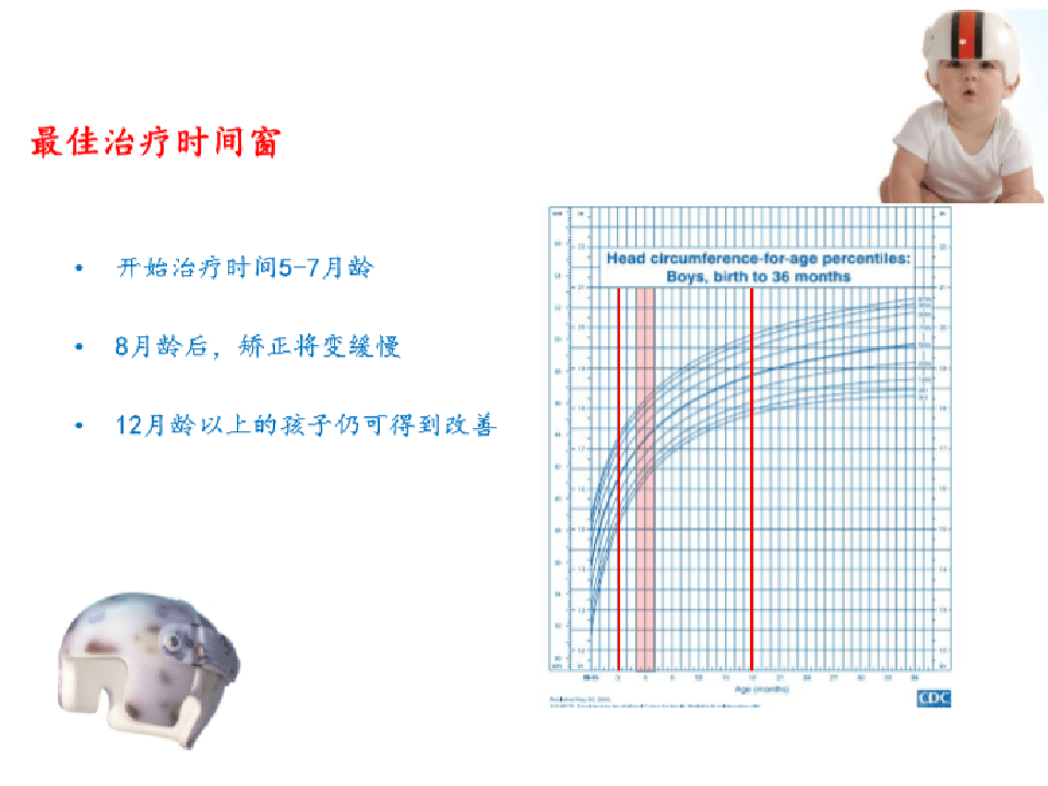 头颅畸形—舟状头_婴儿