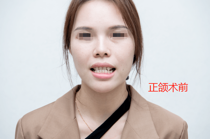 花大钱做正颌手术,真的能彻底解决我的凸嘴问题?拥有尖下巴吗?_照片