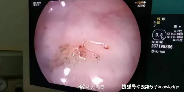 生肉|17岁女孩肠道内发现大量的虫子，寄生虫从何而来？该如何预防
