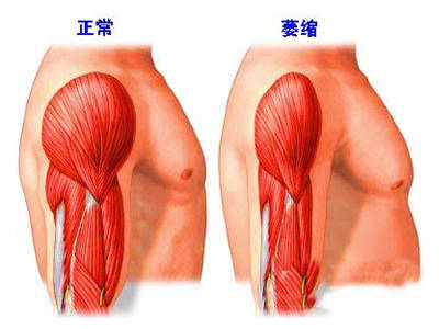 症状|你知道吗？运动神经病是分为上下两种类型的