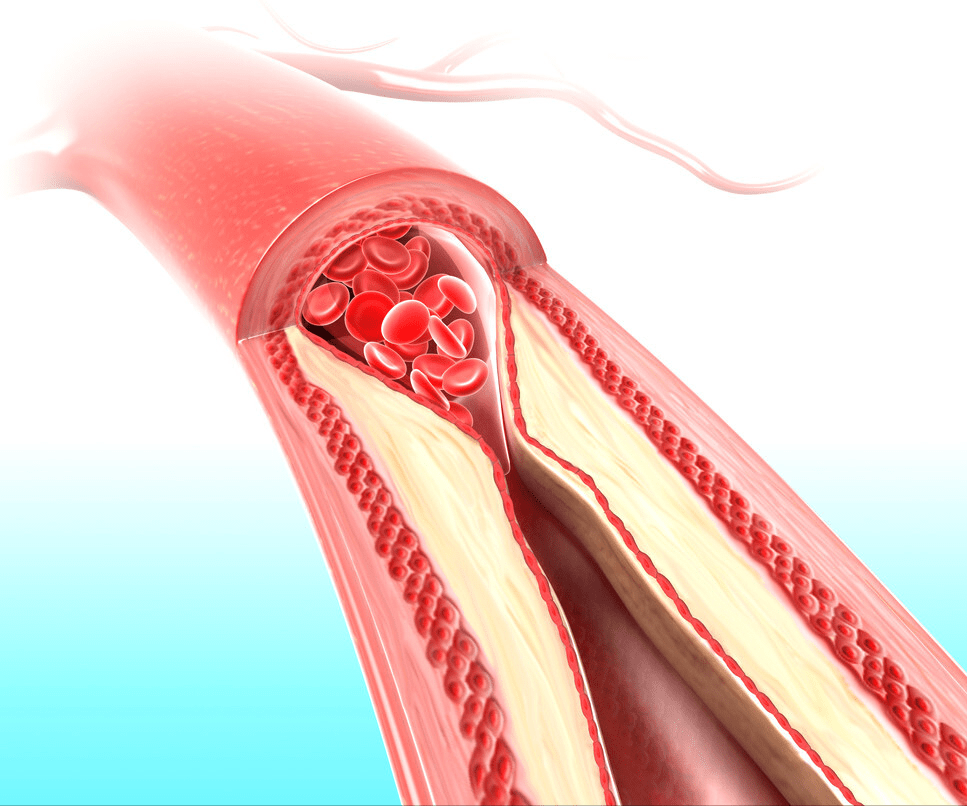 饮食|中年人高血压，为何多是低压高？医生：注意这6点，或许不用吃药