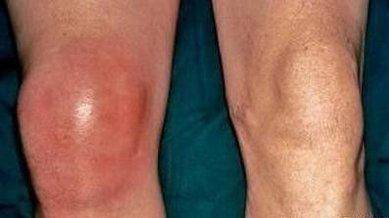 滑膜炎膝盖疼还肿?看看这个妙方你试过没!_膝关节