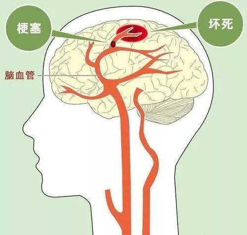 治疗|出血性脑梗死