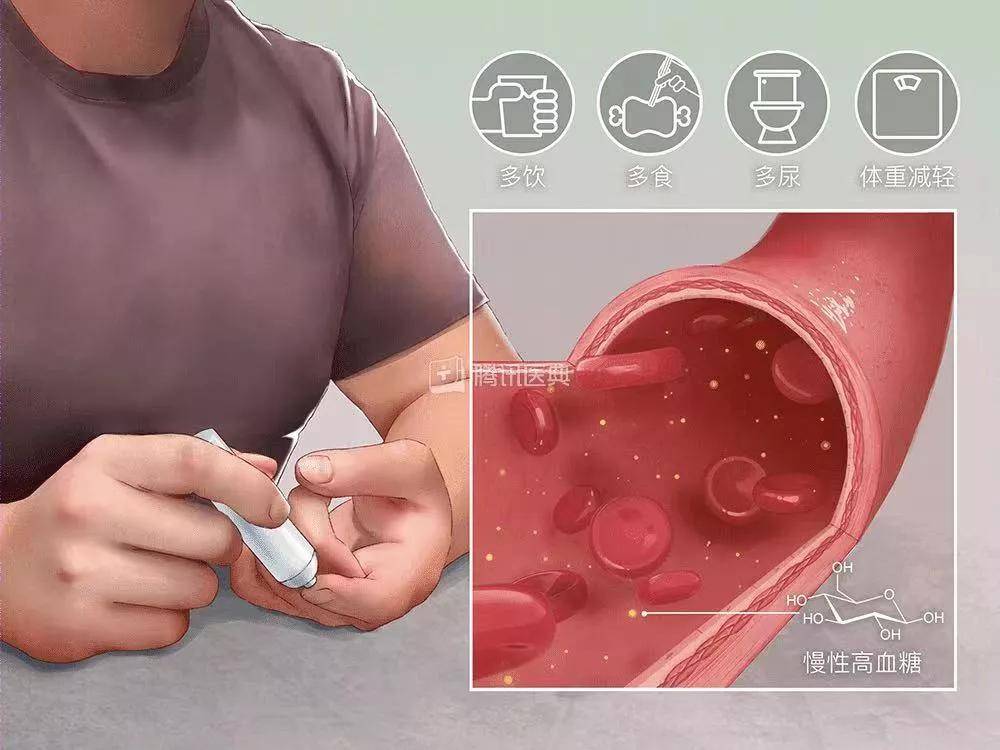 控制|瑞合康复 | 糖尿病小科普