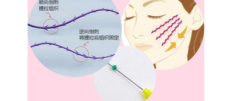 什么ppdo线雕维持时间？ppdo线雕是什么线？怎么抵挡岁月侵染~