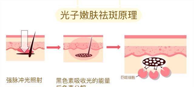 进行并不是所有的人都适合光子嫩肤！