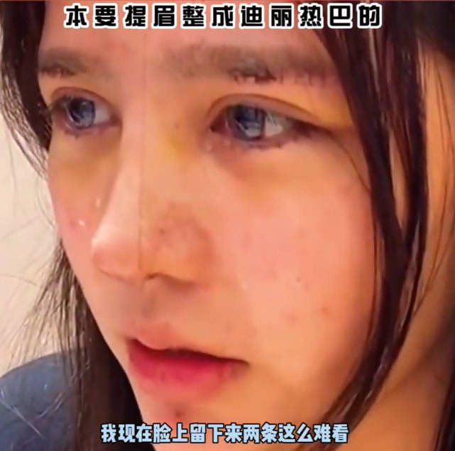 成功女生想整成迪丽热巴，整容失败留下疤痕，哭诉称不敢出去见人了