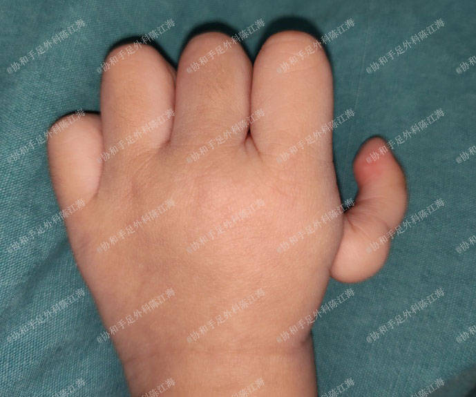 为什么别的小朋友有五根手指我只有四根