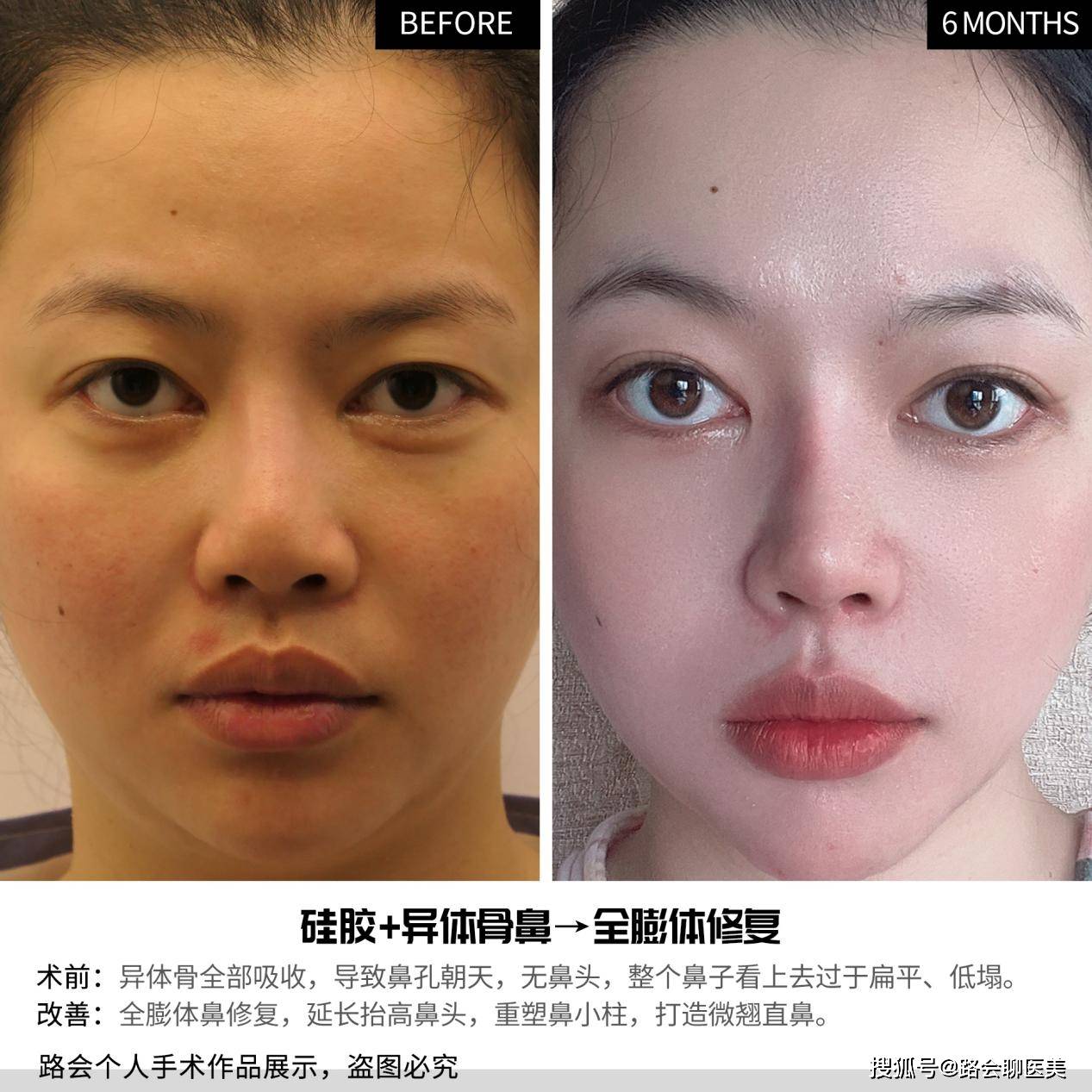 整形医生，你太搞笑了吧？做“妈生鼻子”不就是在做“寂寞”吗？