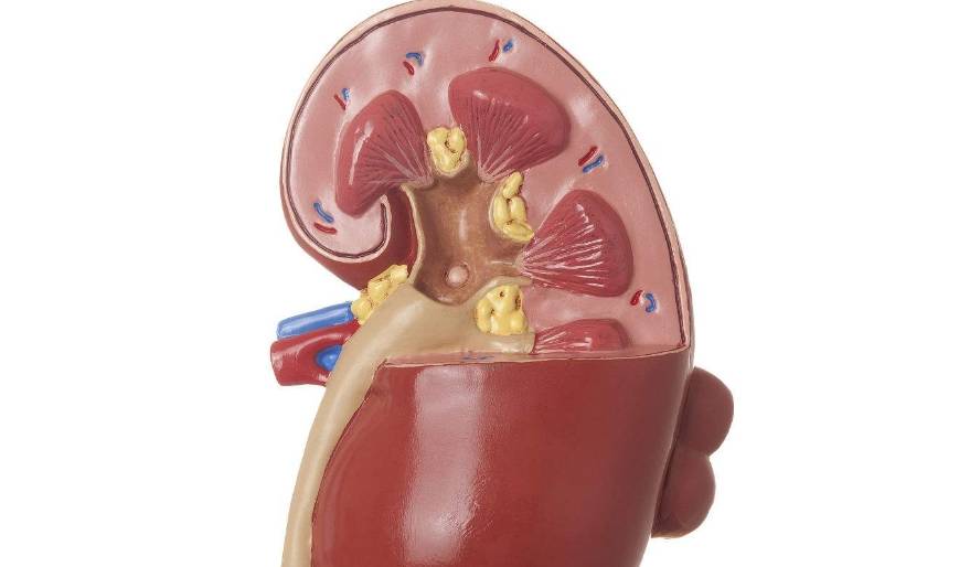 才会|肾结石突然疼是为什么?这几个症状说明肾结石严重化了