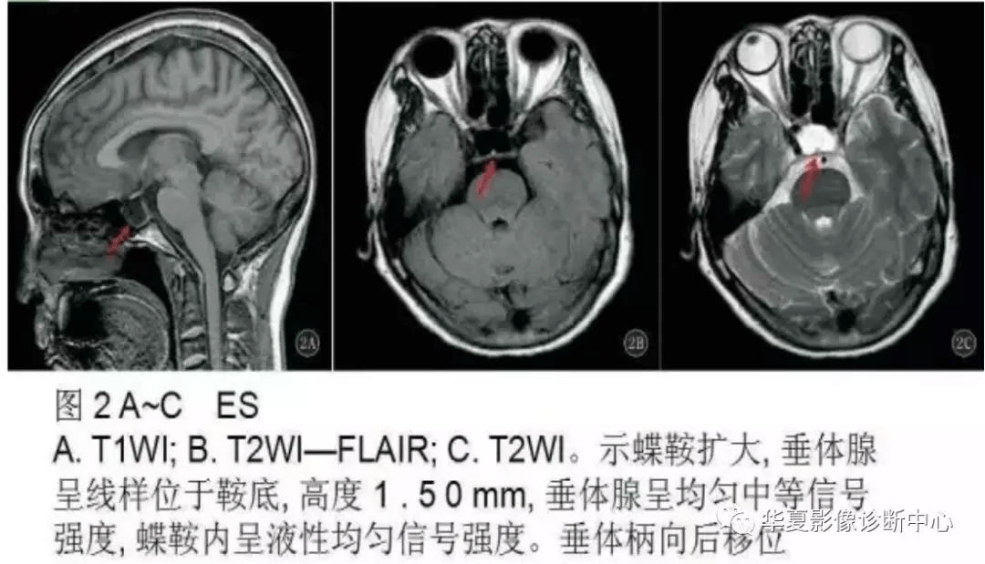 空泡蝶鞍综合症的影像表现及诊断