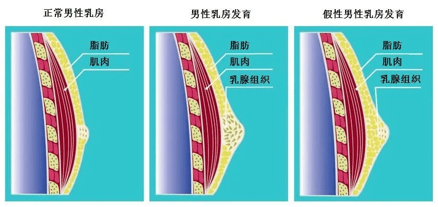 警惕48歲中年男乳房凸起3年多原來男性也有這個病