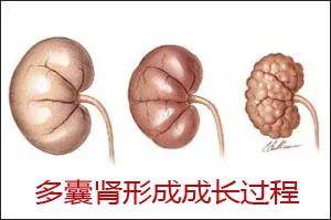 并发症|多囊肾患者需要注意的5大问题