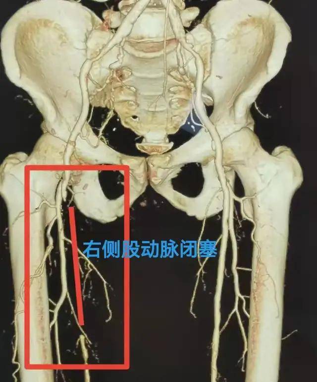 下肢彩超發現右側股淺動脈上段及中段管腔閉塞,右側髂外動脈重度狹窄