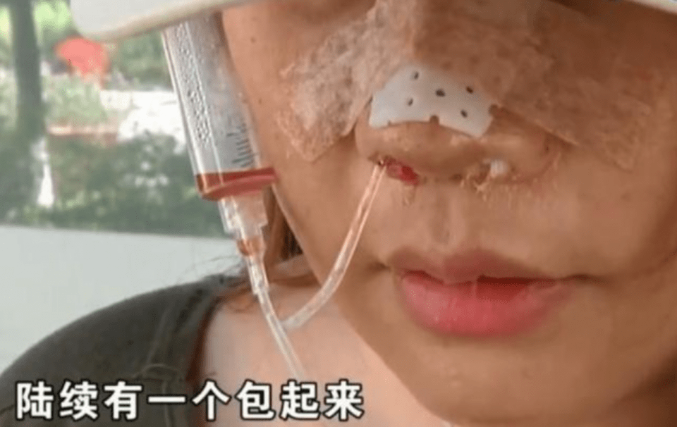 因为女子花6万整容，脸上天天挂着注射器，医院：赔你13000