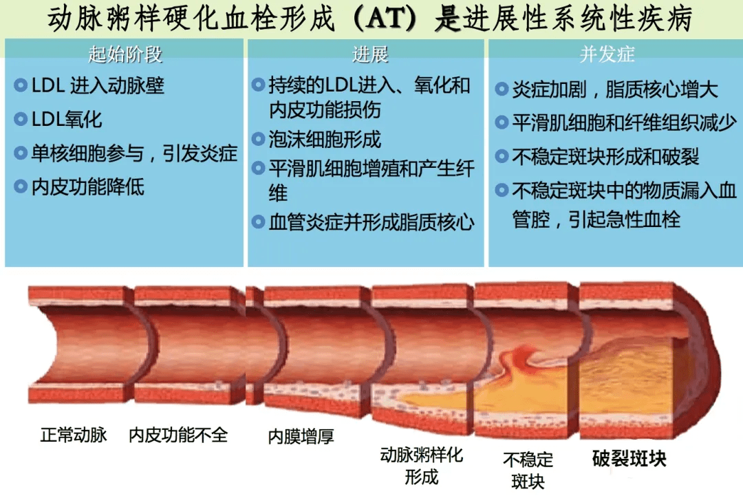 饮食|做到这10点，可预防90%的脑梗发生！