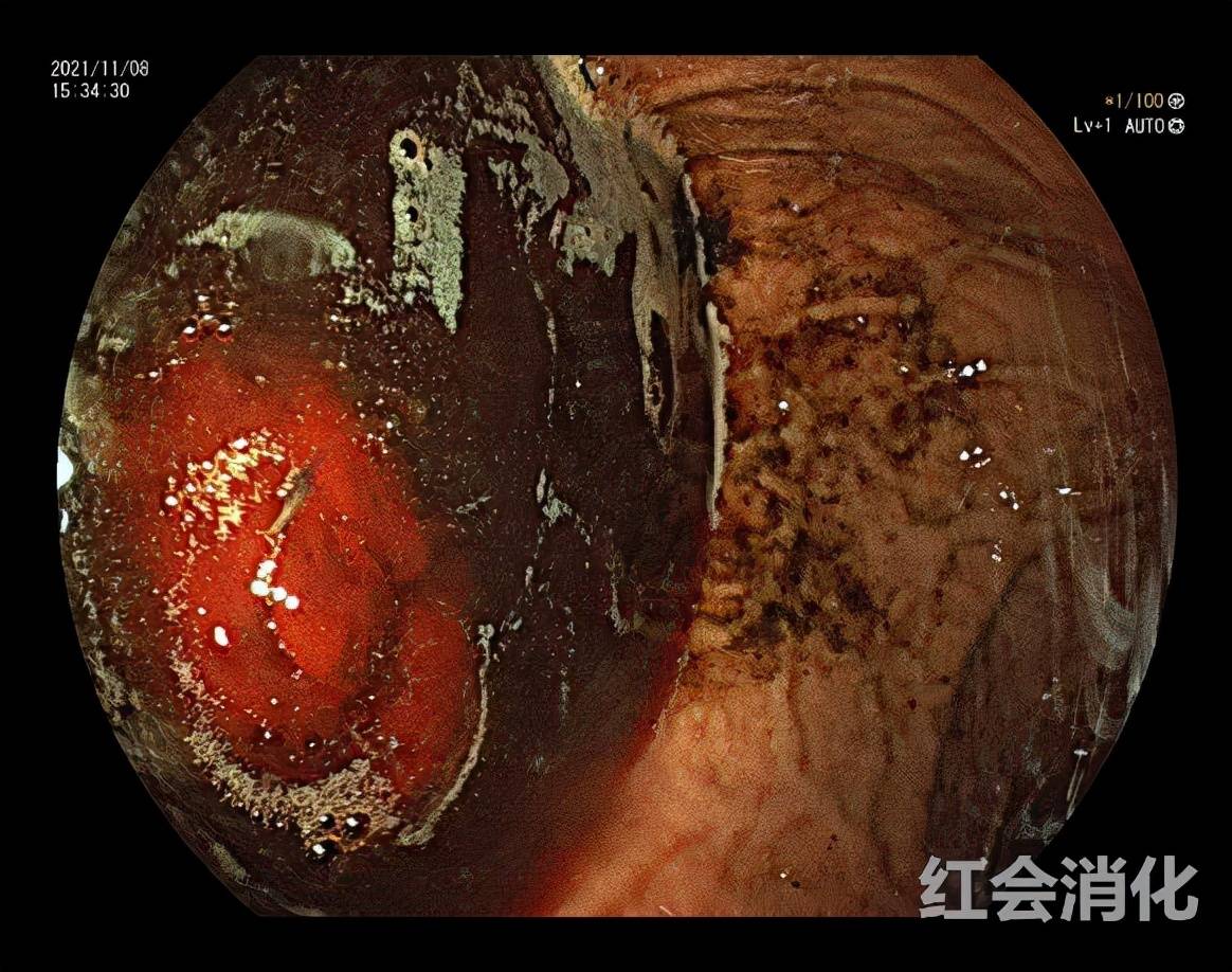 休克|小伙遇车祸消化道大出血休克 西安市红会医院紧急救治挽生命