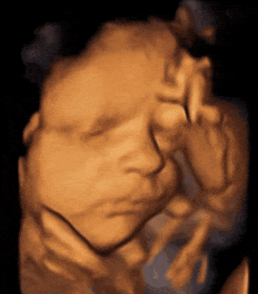 照四维彩超的最佳时间,因为胎儿24周左右正是大脑突飞猛进的发育时期