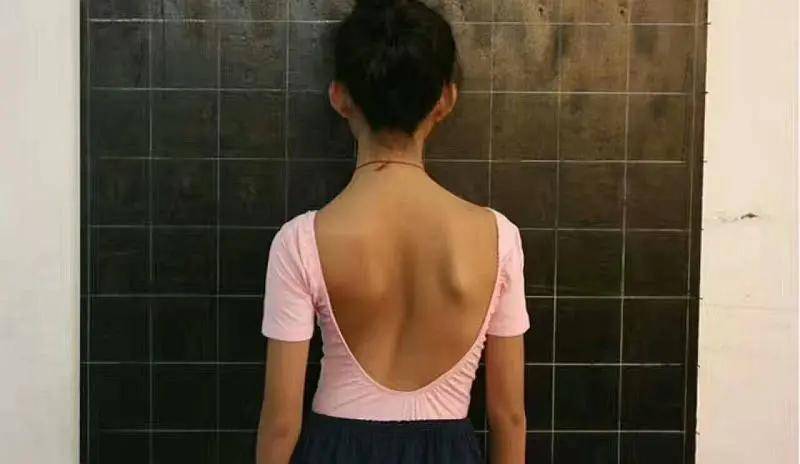 有以上25%的青少年患有青少年脊柱侧弯,70%-80%的中小学生有圆肩,驼背