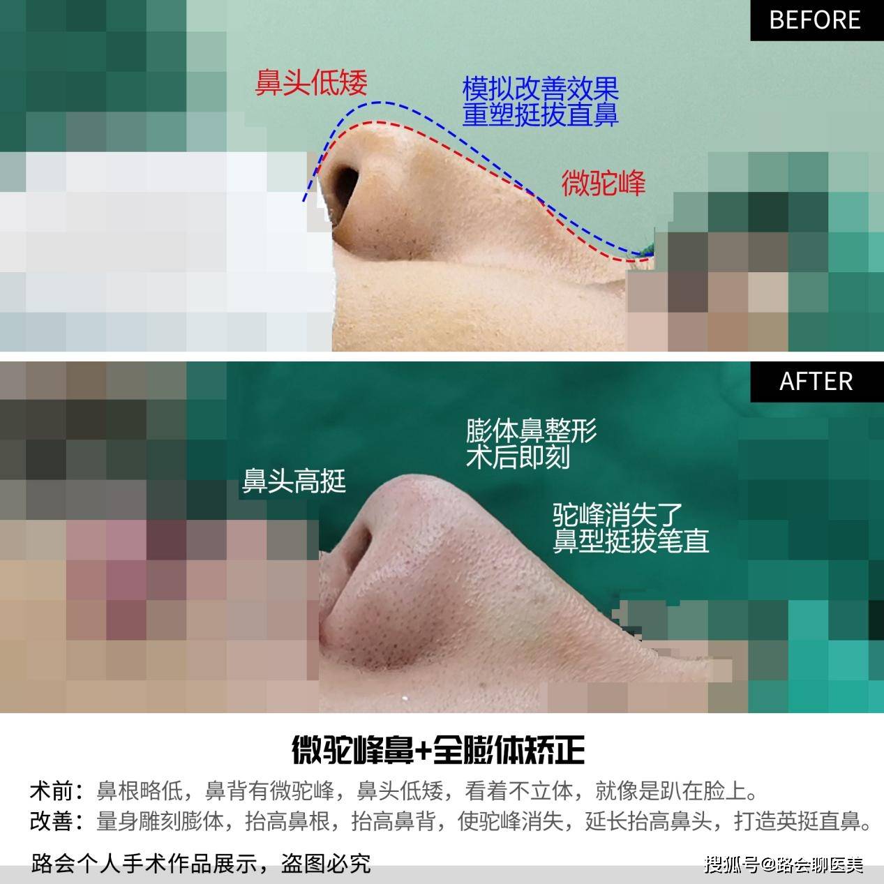 缺点那些整形医生可能不会告诉你的，鼻整形材料的缺点？