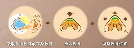 地基100个鼻基底塌陷的人，99个都想做3D打印鼻基底
