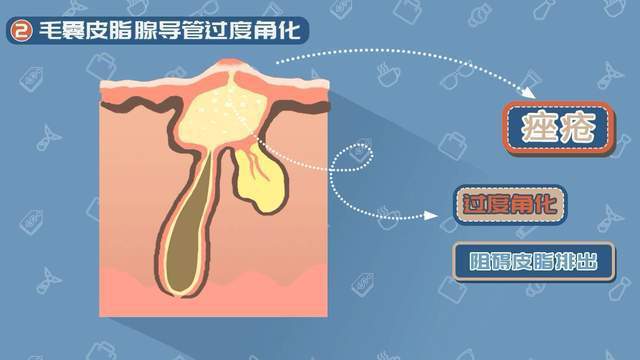 能力脸上痘痘越多，男人那方面能力越强？真的假的？