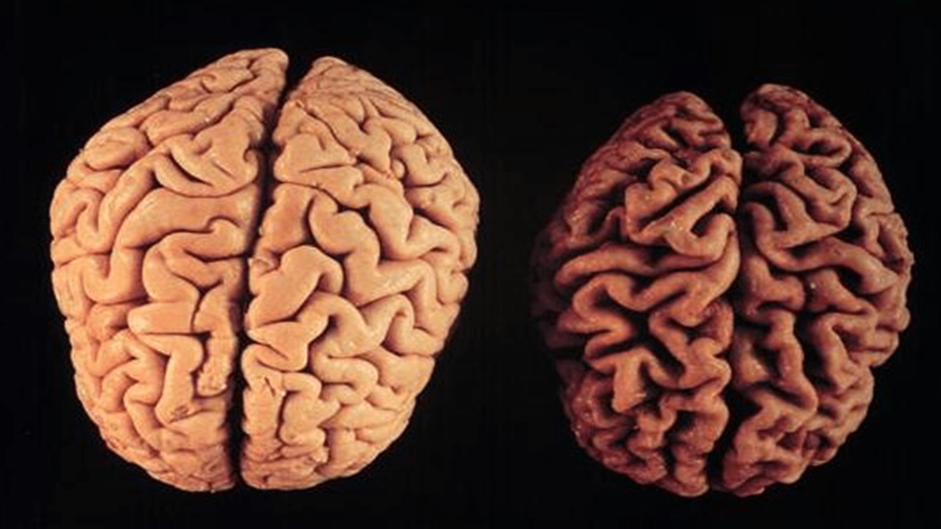 颈椎|病起来“要命”，中风、脑瘫要当心，别等病了才后悔莫及