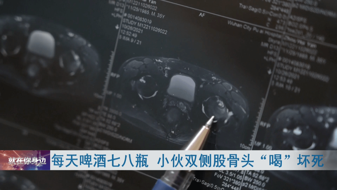 股骨头|27岁小伙长期喝它，股骨头竟成黑色！很多人都爱喝