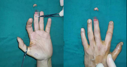 指尖完全离断,郑州仁济医院高难度再植保全手指!