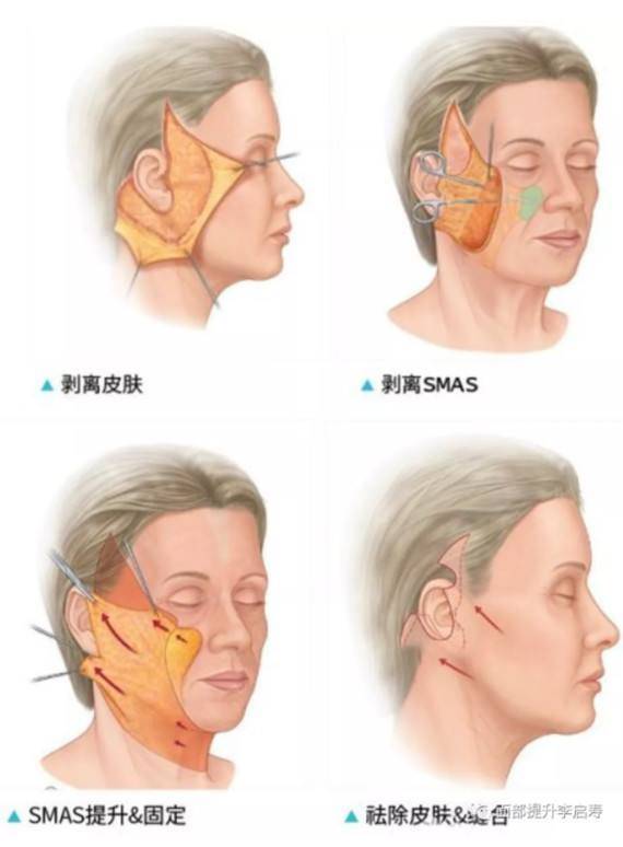 玛吉苹果肌复位术怎么做?这4种办法彻底解决面中部衰老！