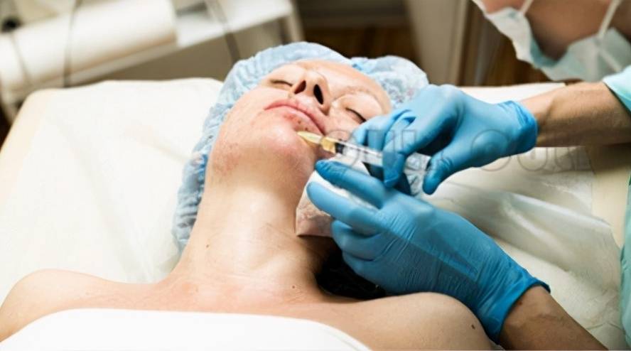 脸部全面还原:脸部脂肪填充恢复过程，全脸脂肪填充5到10天照片~