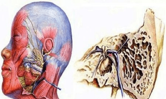 當腫瘤位於顳骨內段內時面癱較重,位於腮腺內時面癱較輕或早期無面癱.