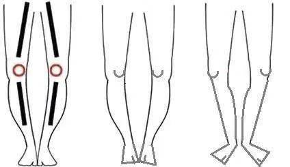 o型腿(膝内翻)分体分级和康复训练_膝盖_安阳_医疗