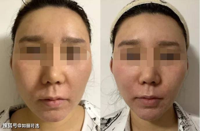 玛吉花3w做的热玛吉没给看二维码，很担心是假的，完全睡不着