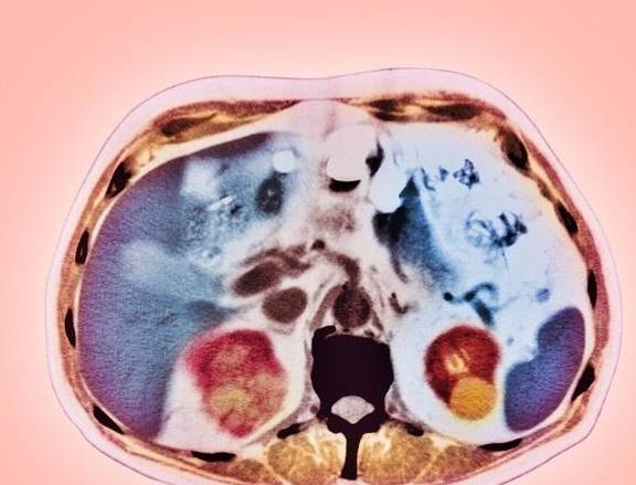 症状|肾囊肿严重可致尿毒症!6个早期信号,希望你能早点了解